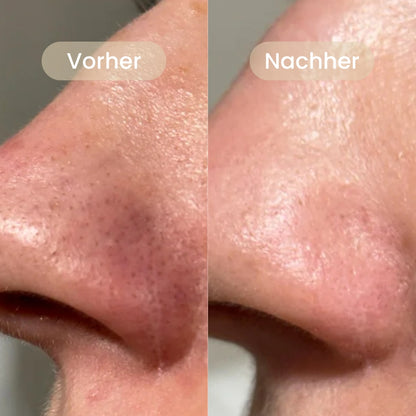 BHA Koreanische Peel Shot – Sichtbar reinere Poren nach nur einer Anwendung