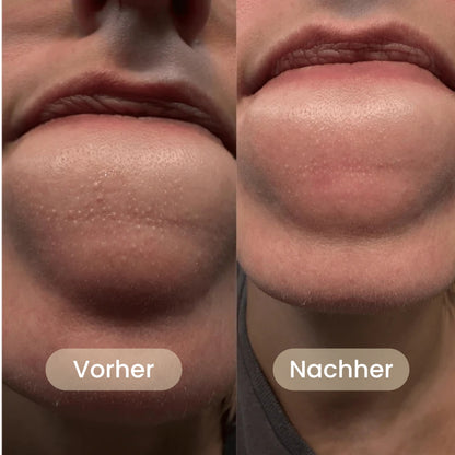 BHA Koreanische Peel Shot – Sichtbar reinere Poren nach nur einer Anwendung