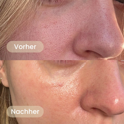 BHA Koreanische Peel Shot – Sichtbar reinere Poren nach nur einer Anwendung