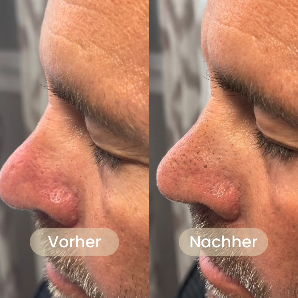 BHA Koreanische Peel Shot – Sichtbar reinere Poren nach nur einer Anwendung