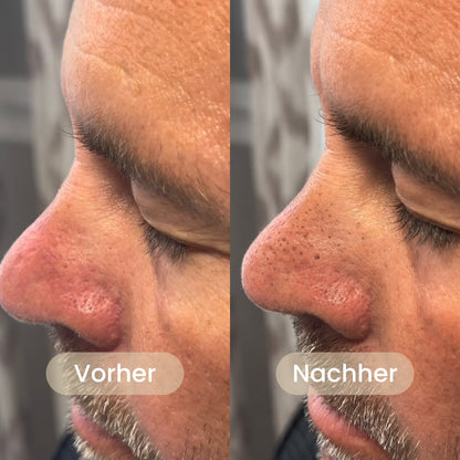 BHA Koreanische Peel Shot – Sichtbar reinere Poren nach nur einer Anwendung